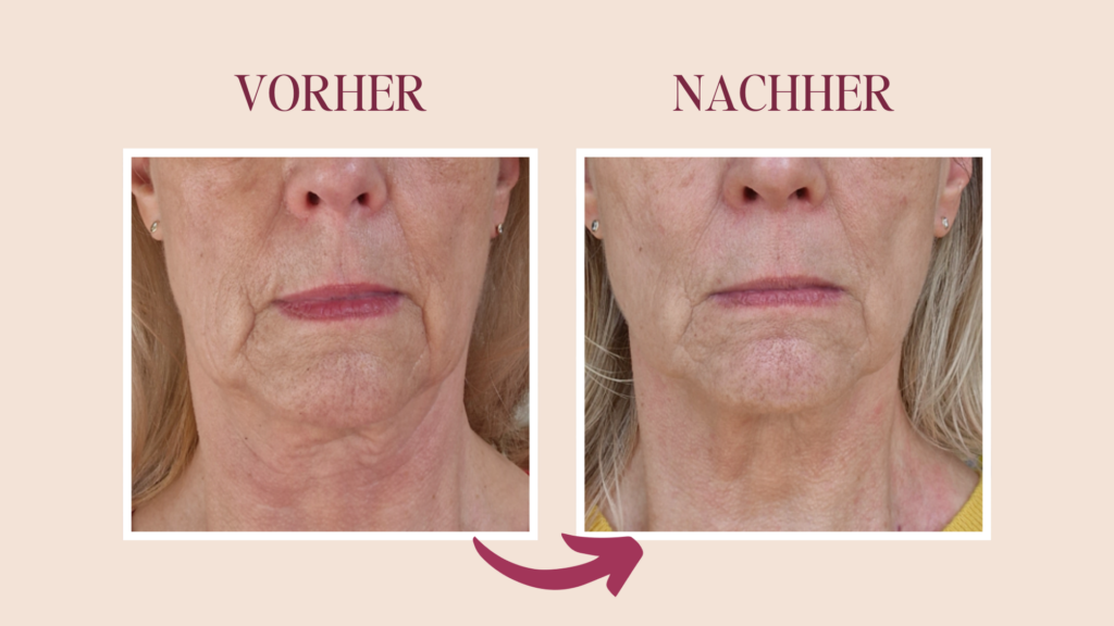 Hängende Wangen liften mit Gesichtstraining