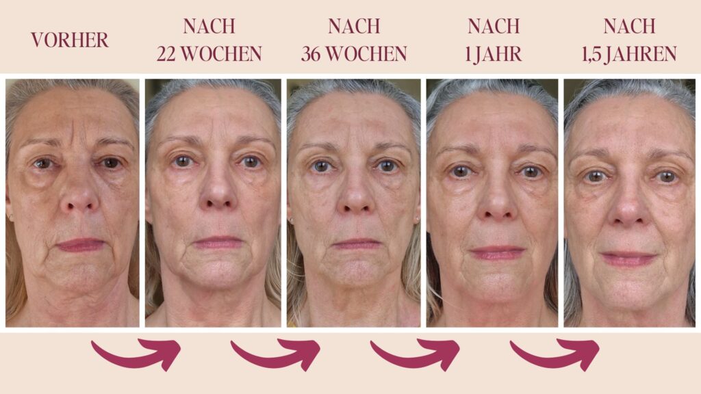 Elisabeth: Hängende Wangen geliftet mit Gesichtstraining