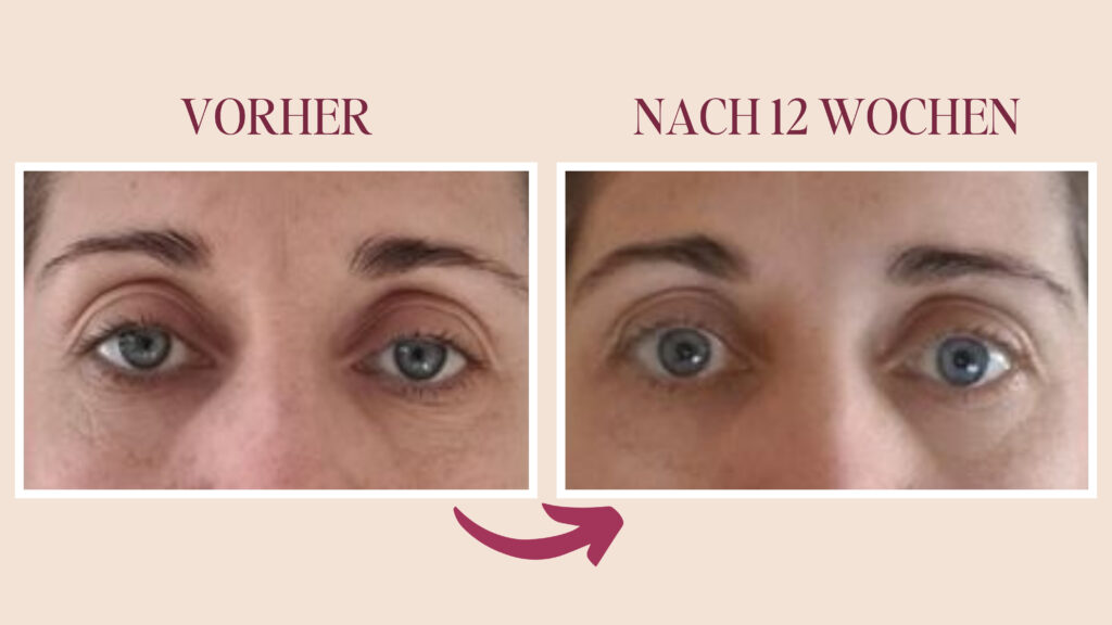 Schlafzimmerblick oder Schlupflider?