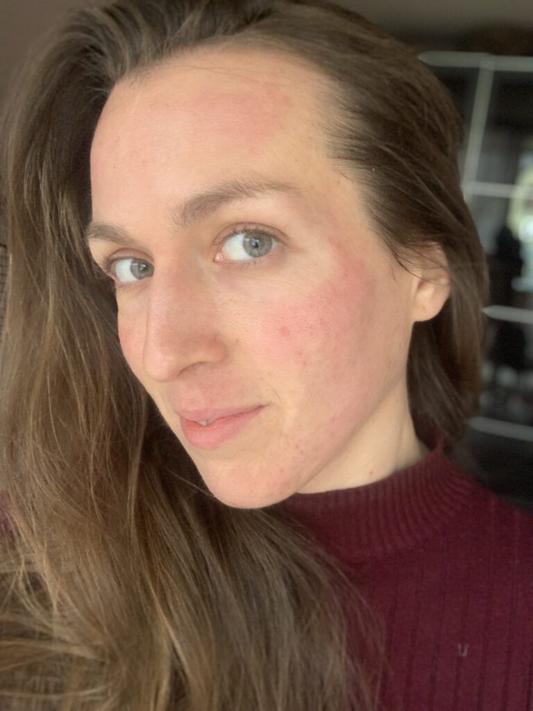 microneedling als anti aging - erfahrung