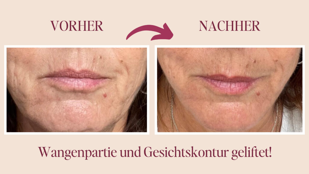 Hängebäckchen weg mit Gesichtstraining