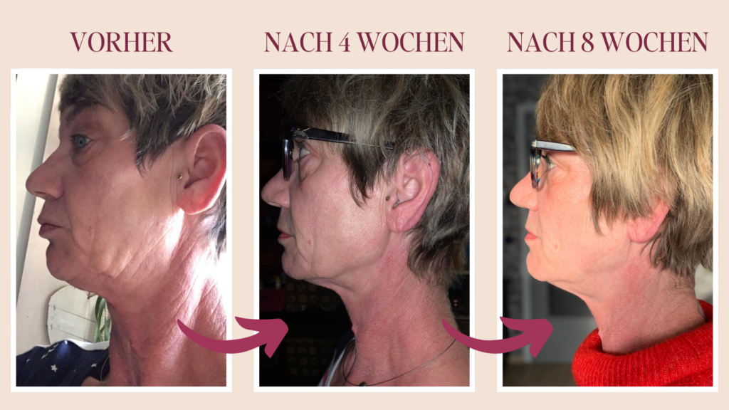 Venusringe und Halsfalten // Vorher-Nachher