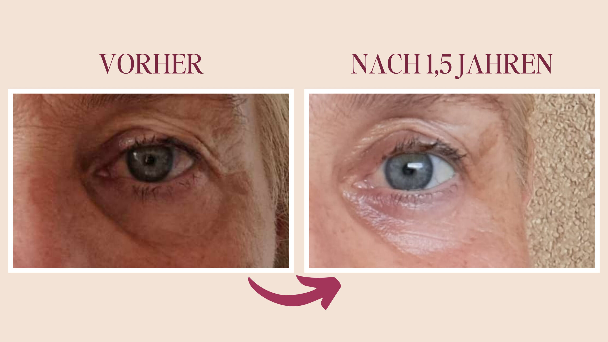 Monika / Faceyoga Augenringe vorher nachher nachher