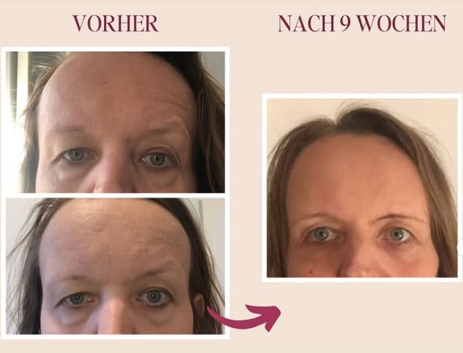 Asymmetrie im Gesicht_ ungleiche Augen und Schlupflider