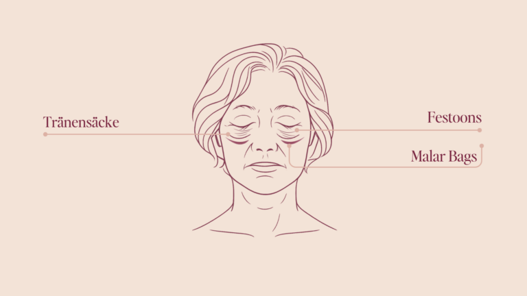 Unterschiede Malar Bags & Festoons & Tränensäcke
