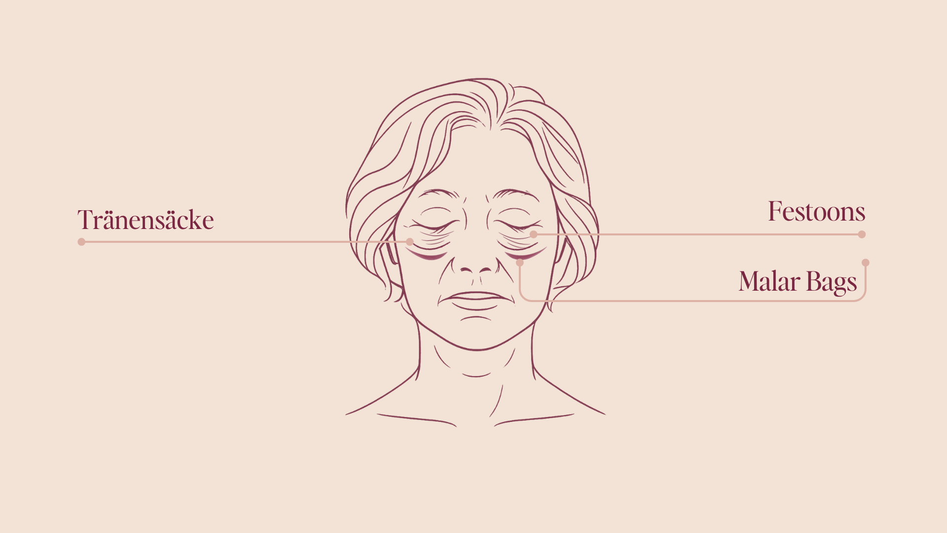 Unterschiede Malar Bags & Festoons & Tränensäcke