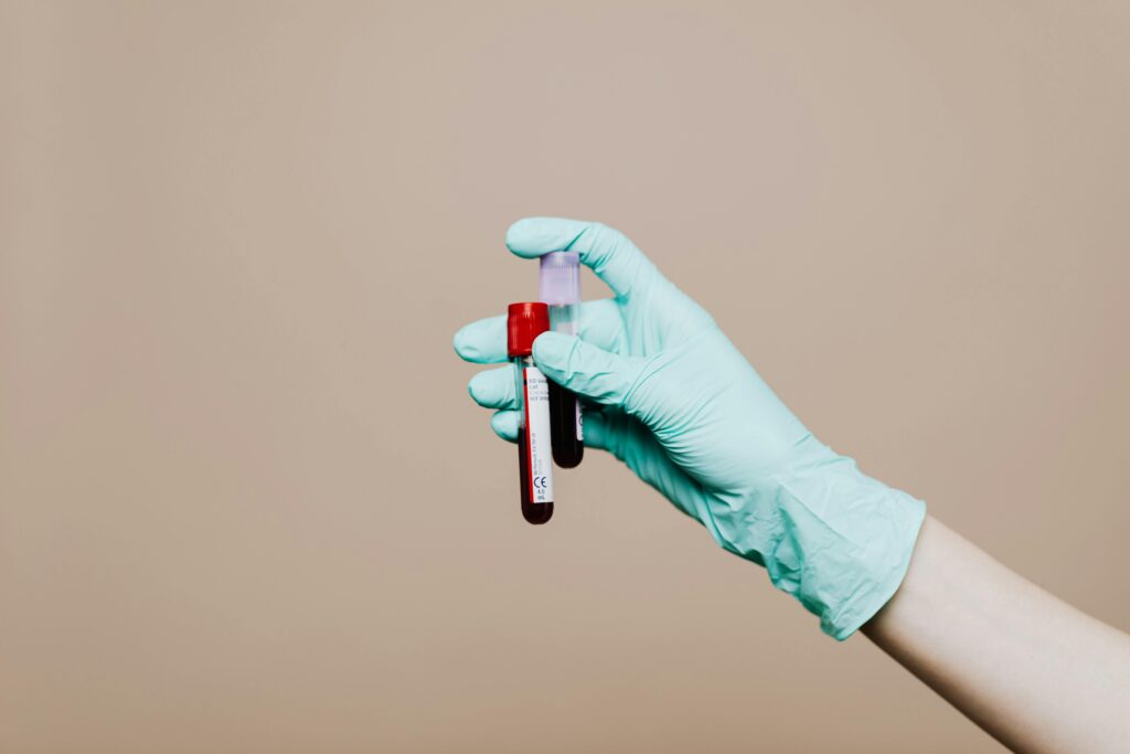 Vampire Lifting - PRP-Behandlung - Erfahrung