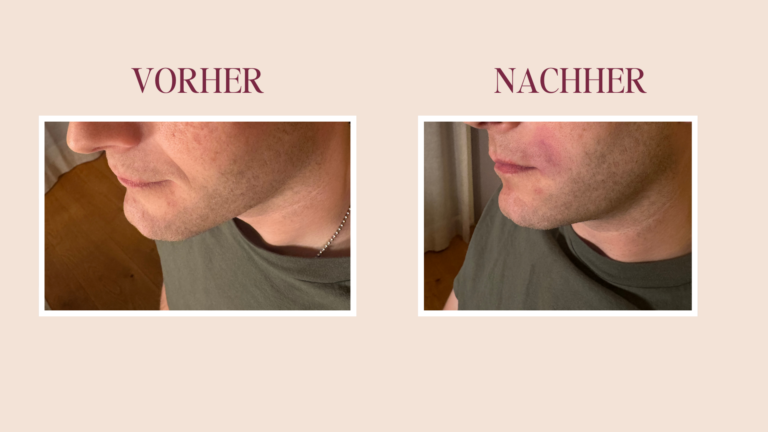 Nasolabialfalten Vorher Nachher / Face Cupping