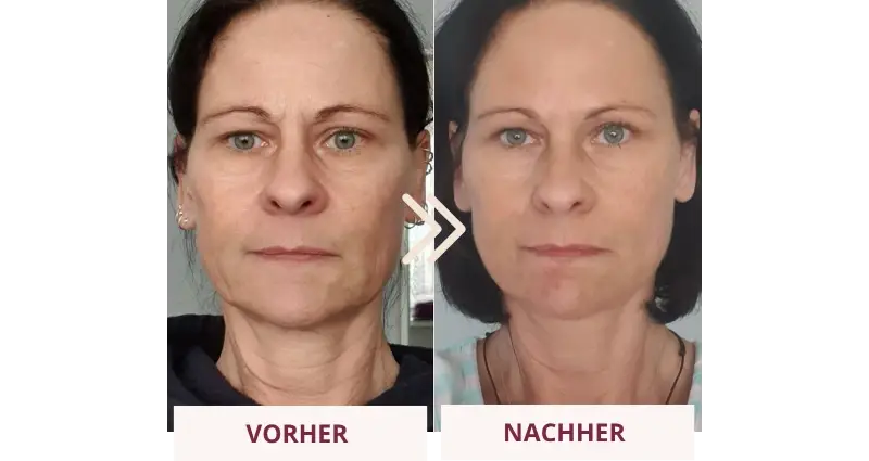 Sandra Reiterer – Vorher-Nachher, gesamtes Gesicht